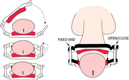 The Dribblestop® Male Urinary Incontinence Clamp - ActivKare